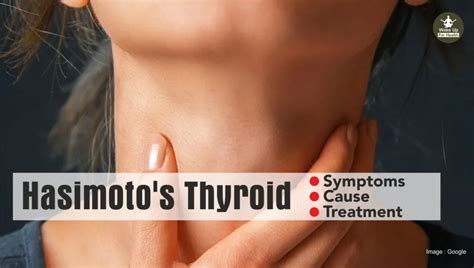 Hashimotos Thyroiditis Symptoms Causes Treatments