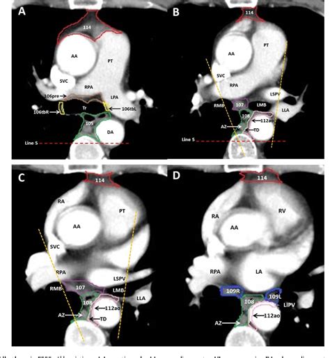 Figure 3 From Atlas Of The Thoracic Lymph Nodal Delineation And