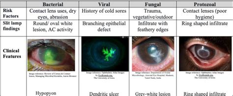 Keratitis Mind The Bleep