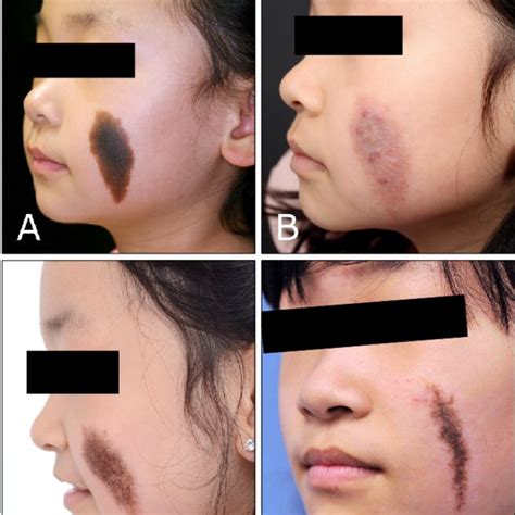 Flow Chart Of Patients With Congenital Melanocytic Nevi Cmn Treated