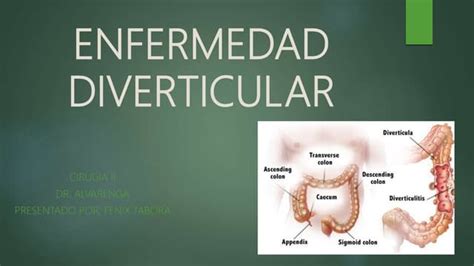 Diverticulitis Causas Síntomas Y Tratamiento Ppt