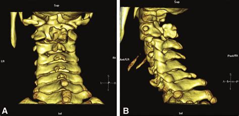 A Ct Dimensional Reconstruction Posterior Demonstrating Aplasia Of