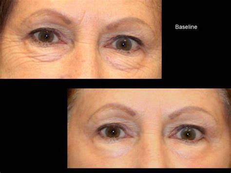 Fractional CO2 Laser Before & After - Charlotte Huntersville, NC ...