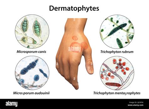 Microsporum Fungus Cut Out Stock Images And Pictures Alamy