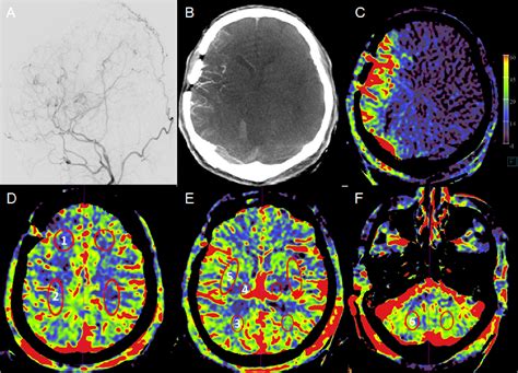 Figure 1 From Vessel Territory Mapping After Cerebral Revascularization