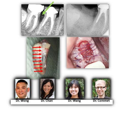 Cracked Tooth Syndrome Renovo Endodontic Studio