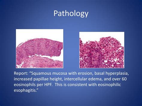 Eosinophilic Esophagitis Histology