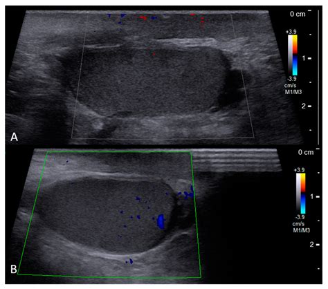 A Rare And Easily Overlooked Case Of Bilateral Traumatic Testicular