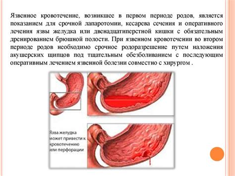 Язвенная болезнь желудка и двенадцатиперстной кишки - презентация онлайн