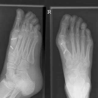 Three months postoperative radiographs following scarf osteotomy | Download Scientific Diagram