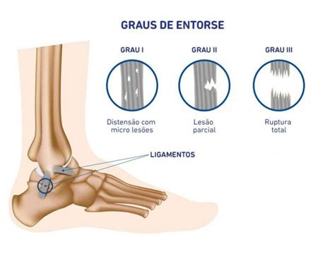 Entorse Do Tornozelo O Que Causa Diagn Stico