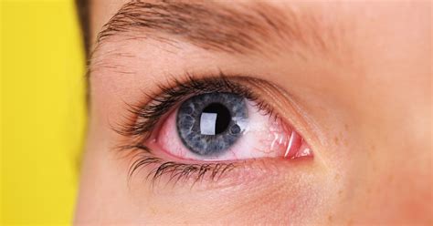 Ocular Syphilis Symptoms As STD Epidemic Causes Eye Problems