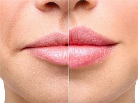 Upper Lip Botox Treatment