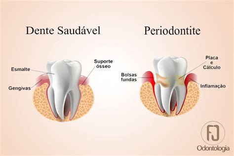 Gengiva Inchada E Dolorida No Último Dente - A gengivite consiste na inflamação do tecido gengival que circunda o ...