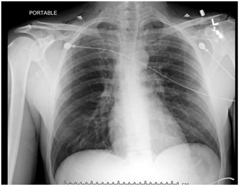 Chest Radiograph Showing Mediastinal Air With Extensive Subcutaneous Download Scientific