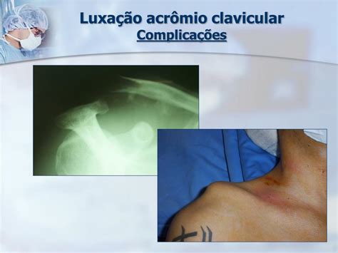 Ppt Luxa O Acr Mio Clavicular Grau Iii Em Pacientes Acima De Anos