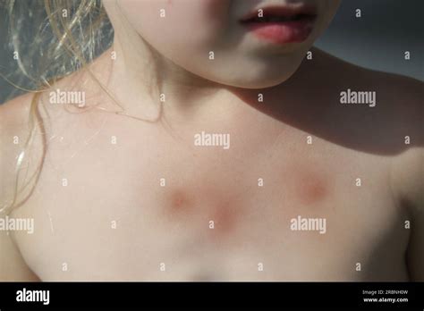 La Niña Tiene Erupción Cutánea Por Alergia O Picaduras De Mosquitos Fotografía De Stock Alamy