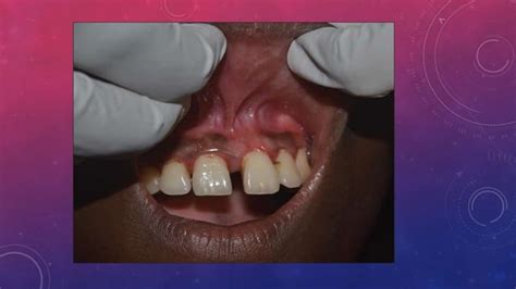 peripheral ossifying fibroma | PPT