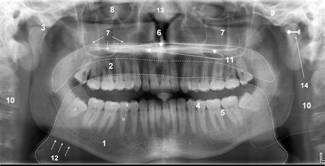 The Panoramic Dental Radiograph For Emergency Physicians Emergency