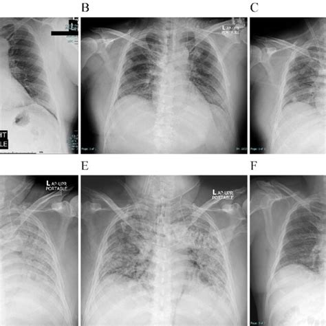 Chest Radiographs Of The Patient A Upon Admission To Another Hospital