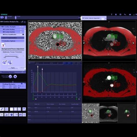 Syngo Mr Cardiac Flow Siemens Healthineers Usa