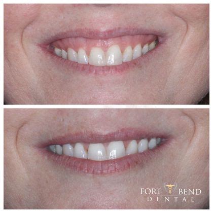 Botox Treatment to Correct Gummy Smile - Gummy Smile - Before and After ...