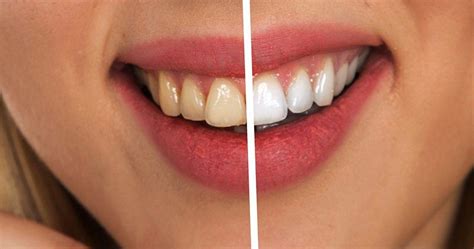 Comment blanchir les dents Découvrez notre recette secrète