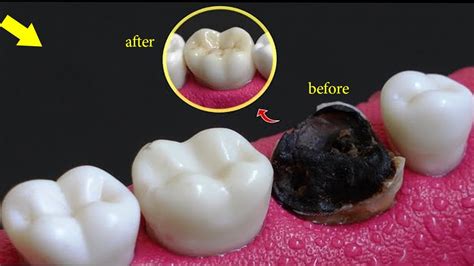 Incredible Restoration Of Tooth By Root Canal And Zirconia Crown