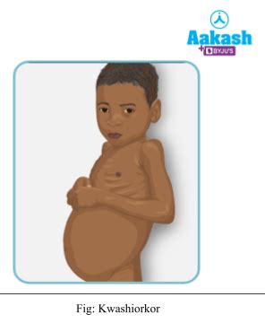 Types Of Kwashiorkor