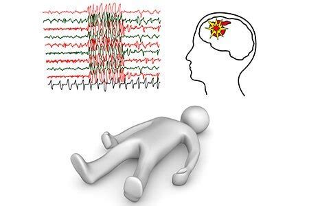 Epilepsy or Seizures Disorders: Convulsions, Symptoms, Treatments, Types