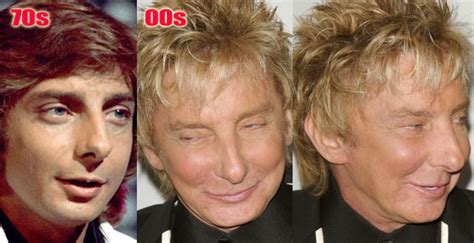 Barry Manilow Plastic Surgery Before And After Facelift Famous