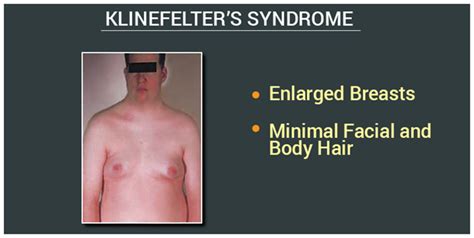 Klinefelter Syndrome Causes Symptoms Treatment - Tabitomo