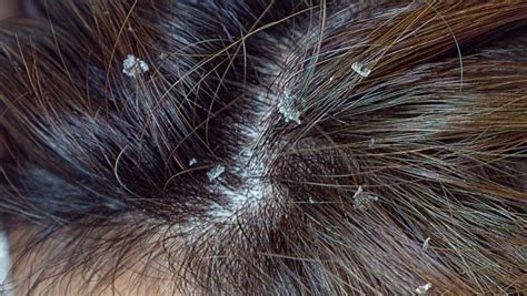 What Does Dandruff Look Like? Here's How to Tell - Her Beauty Plug