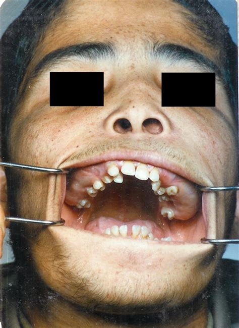 Superior Repositioning Of The Maxilla In Thalassemia Induced Facial