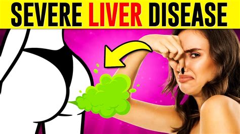 12 Weird Signs That You Have Liver Damage Youtube