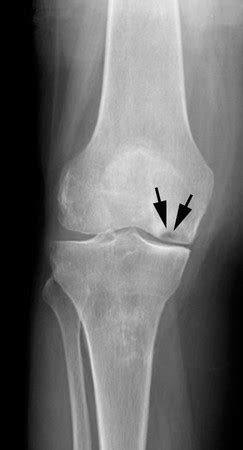 What Is Avascular Necrosis? - Definition, Causes, Symptoms & Treatment ...