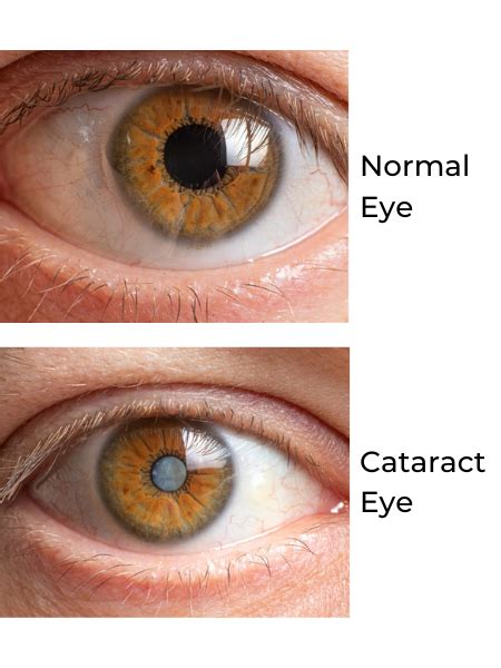 What Are Cataracts Cataract Types And Treatments Icon Eyecare