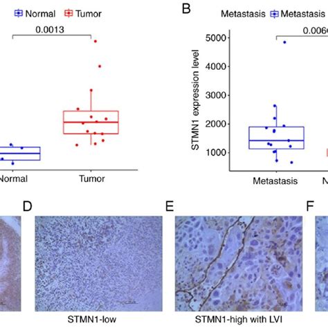 STMN1 Expression Differences And Immunohistochemical Staining For STMN1