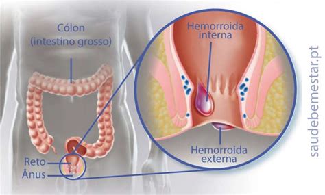 Como É A Hemorroida Externa - Hemorroidas Externas Leves