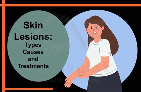 Understanding Skin Lesions Types Causes And Treatments Curevigor