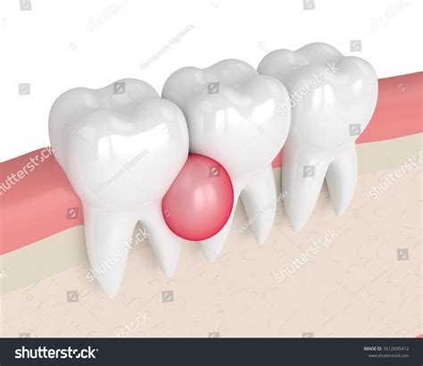 3d Render Teeth Gums Cyst Over Stock Illustration 1612695412 | Shutterstock