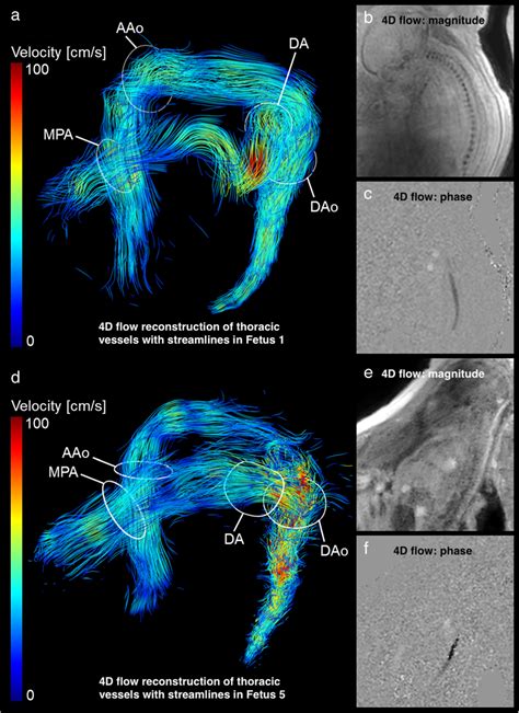 D Flow Mri Based Characterisation Of Flow Dynamics End Diastolic