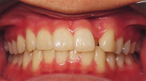 Class Ii Division 1 Malocclusion Deep Overbite Severe Upper Crowding Case Gallery