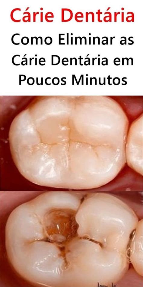 Como Eliminar As Cárie Dentária Em Poucos Minutos