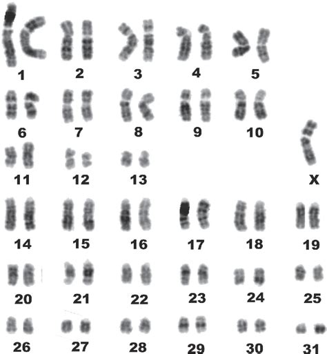 Monosomy X