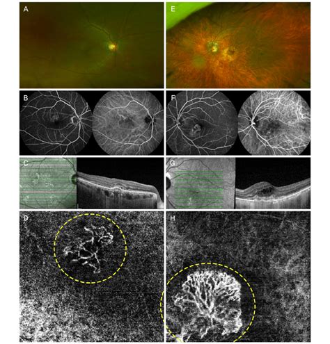 Representative Images Of Two Subtypes Of Choroidal Neovascularization