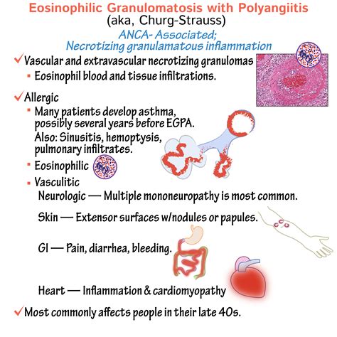 Pathology Glossary: Eosinophilic granulomatosis with polyangiitis (aka ...