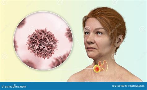 Thyroid Cancer In Women Stock Illustration Illustration Of Medicinal