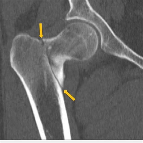 A Ct Scan Showing The Right Intertrochanteric Fracture Of The Right