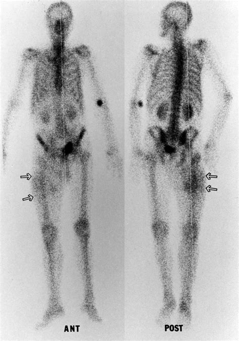 Anterior And Posterior 99m Tc Hmdp Whole Body Bone Images Show